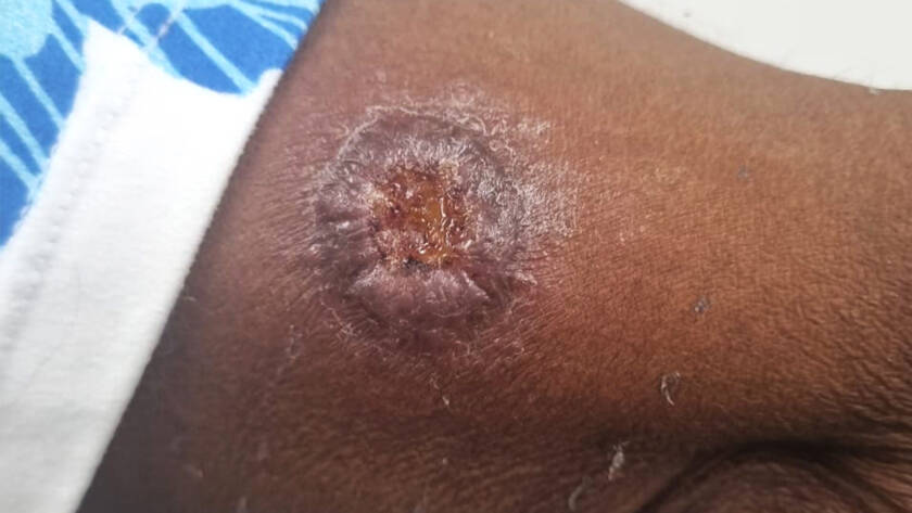 Leishmaniasis
