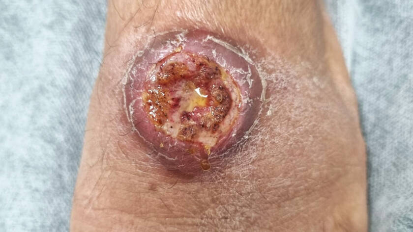 Leishmaniasis